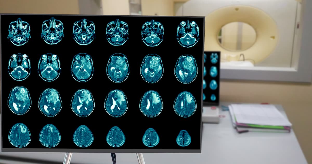 Ліки проти тиску виявили ефект проти раку мозку — нове дослідження