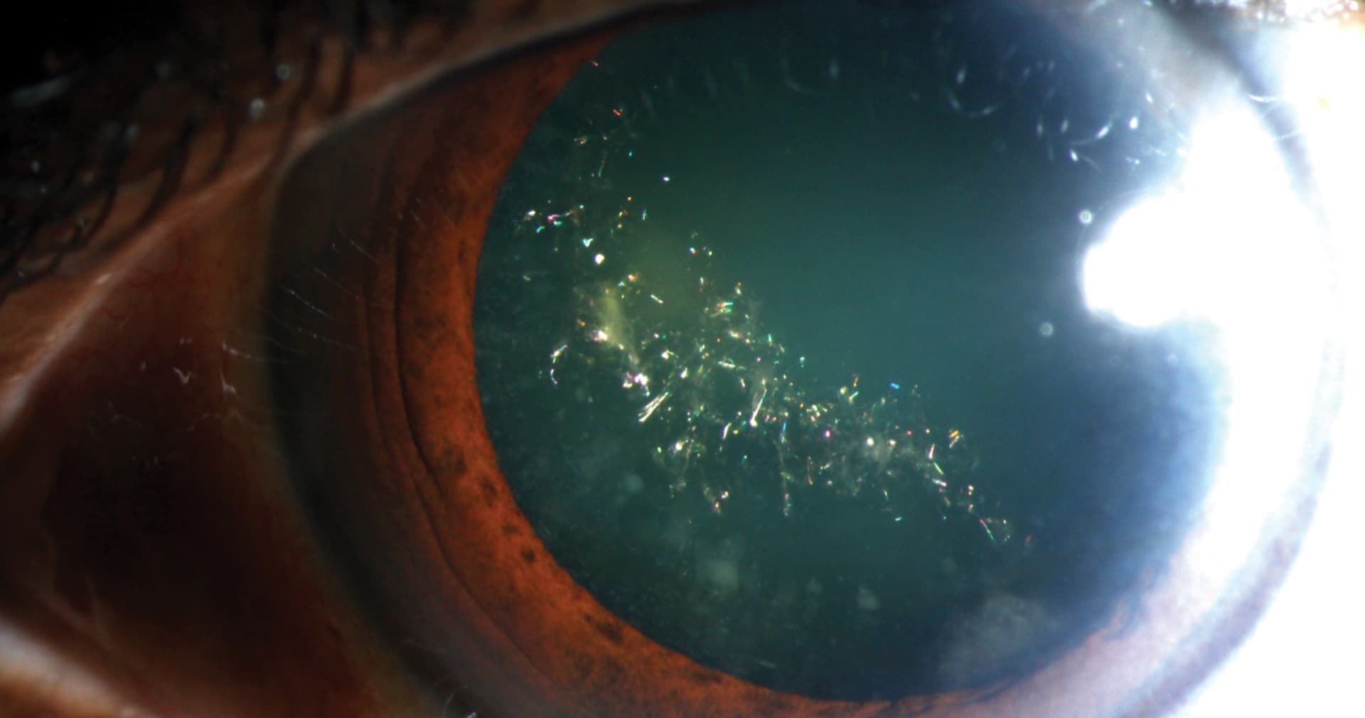 Рідкісна катаракта змушує очі сяяти, як гірлянди